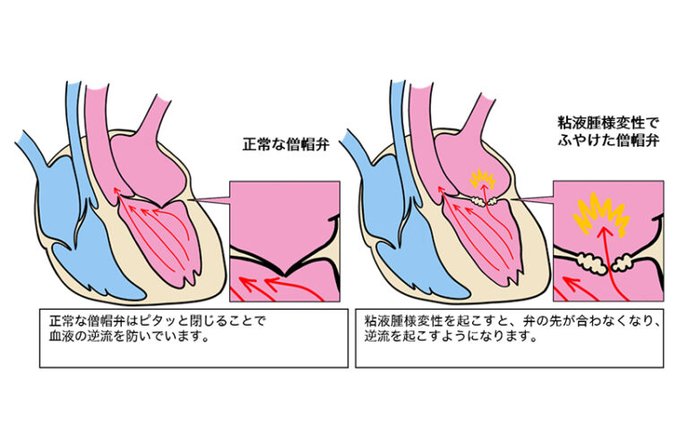僧帽弁閉鎖不全症の診断